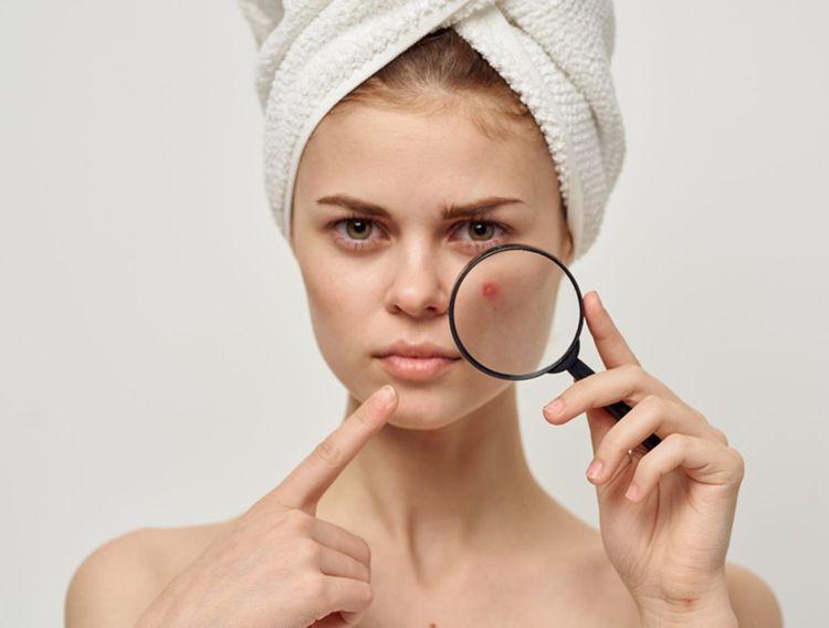 Hướng dẫn cách trị mụn tại nhà hiệu quả và an toàn cho da