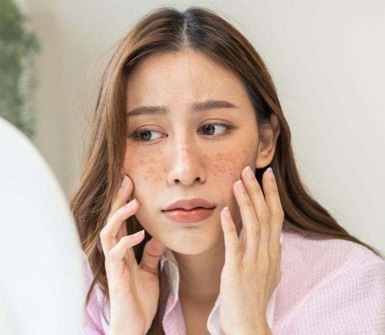 Nám chân sâu: “Vạch trần 4 thủ phạm” khiến da bị nám chân đinh