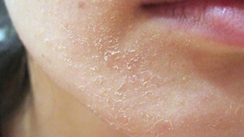Da dễ bị bong tróc, nổi mẩn đỏ và ngứa ngáy
