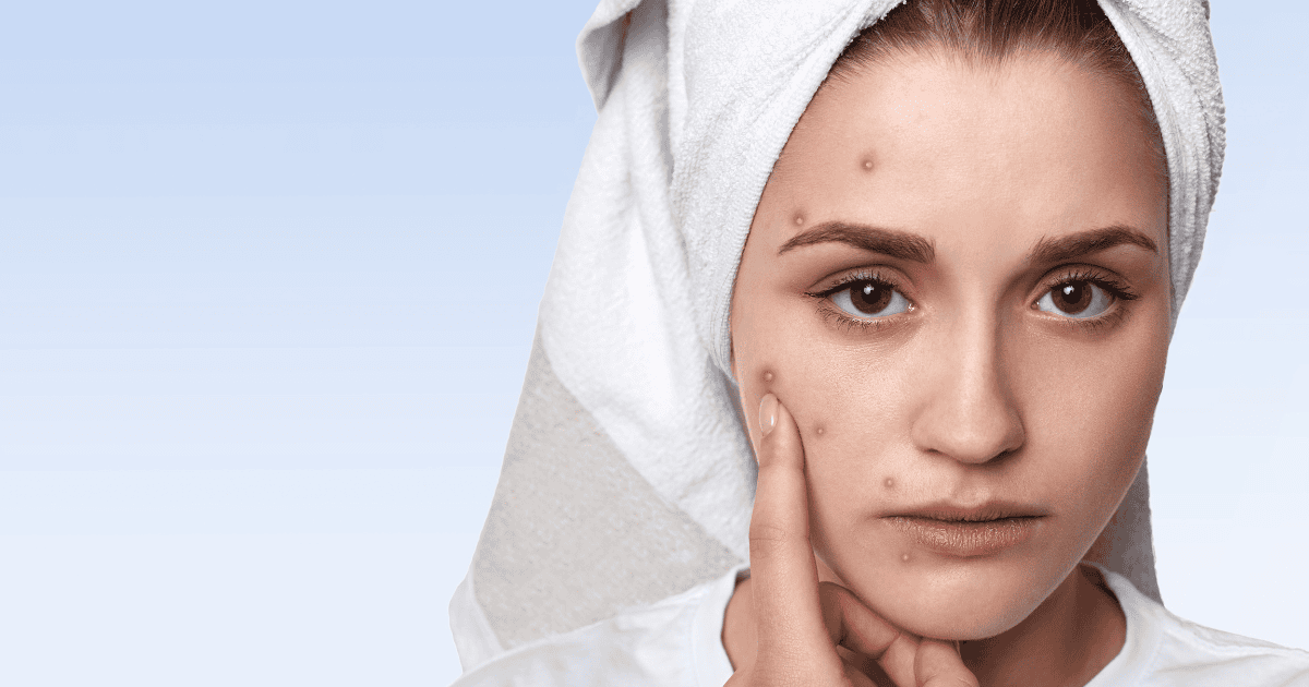 Collagen nào tốt cho da mụn? Top 8 collagen hiệu quả nhất