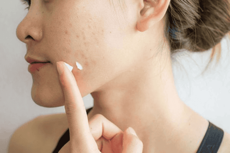 Sử dụng thuốc trị mụn ẩn