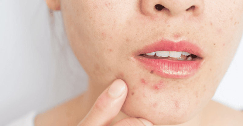 Một số người có thể gặp tác dụng phụ khi sử dụng collagen dạng bột quá liều hoặc không đúng cách