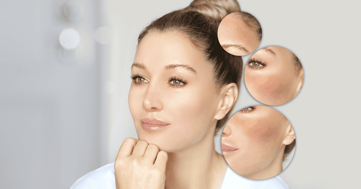 Uống collagen có trị được nám không? Chuyên gia giải đáp
