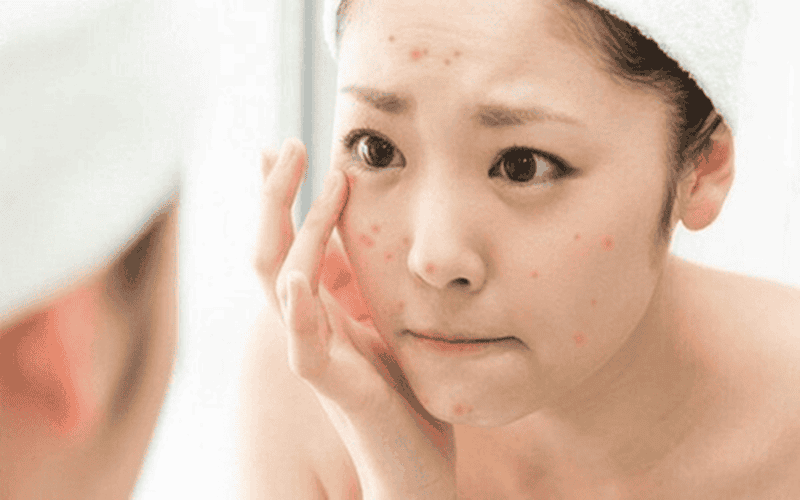 Dùng sai phương pháp điều trị mụn ẩn
