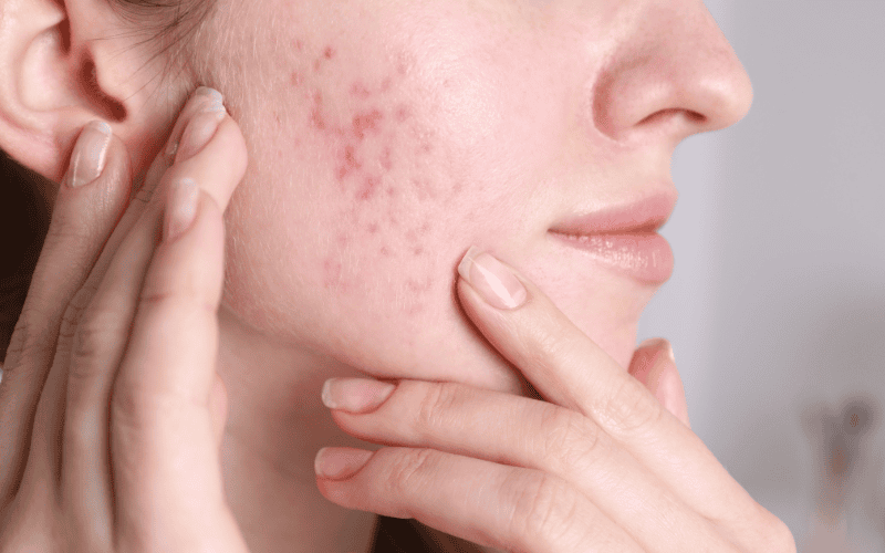 Uống collagen có trị sẹo rỗ không