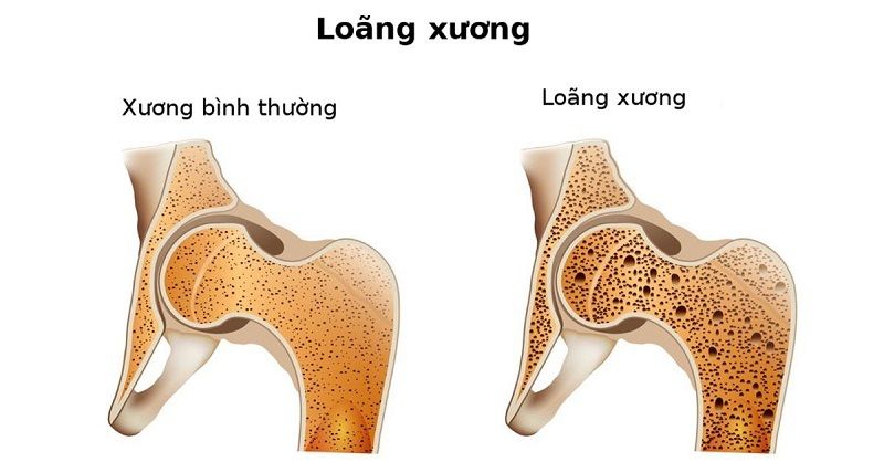 Giảm mật độ xương