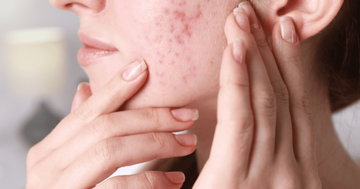 Uống collagen trị sẹo lõm hiệu quả không? Giải đáp chi tiết