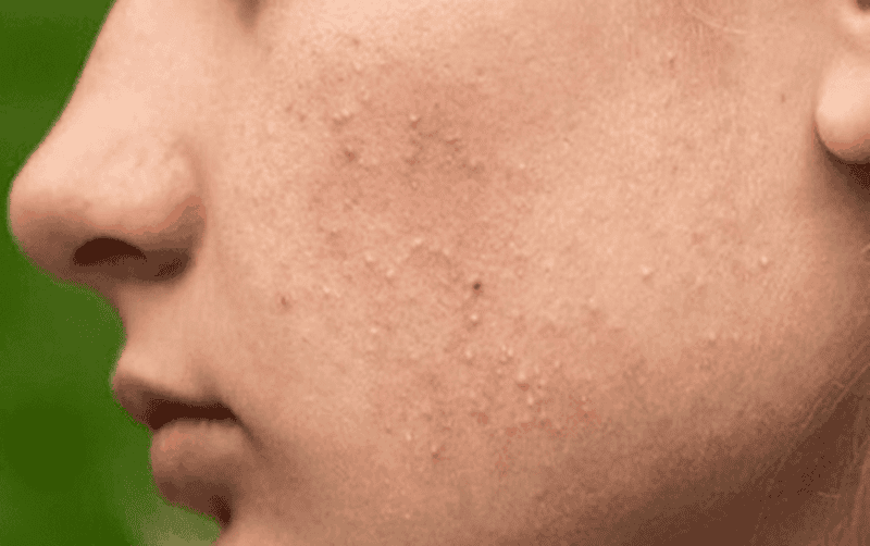 Tại sao mụn ẩn thường xuất hiện ở má