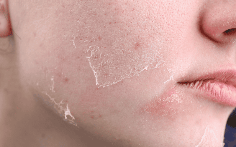 collagen cho da khô cần tập trung vào khả năng dưỡng ẩm sâu và nuôi dưỡng từ bên trong