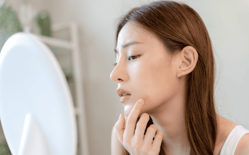Tiêu chí lựa chọn collagen cho da mụn