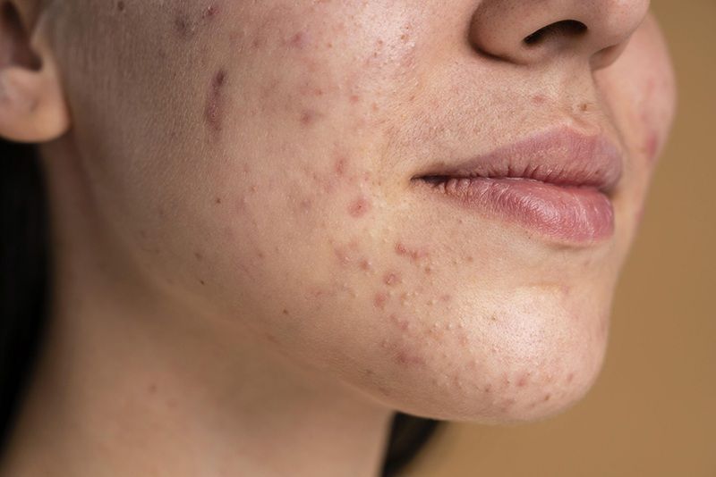 1. Tình trạng mụn thâm là gì?