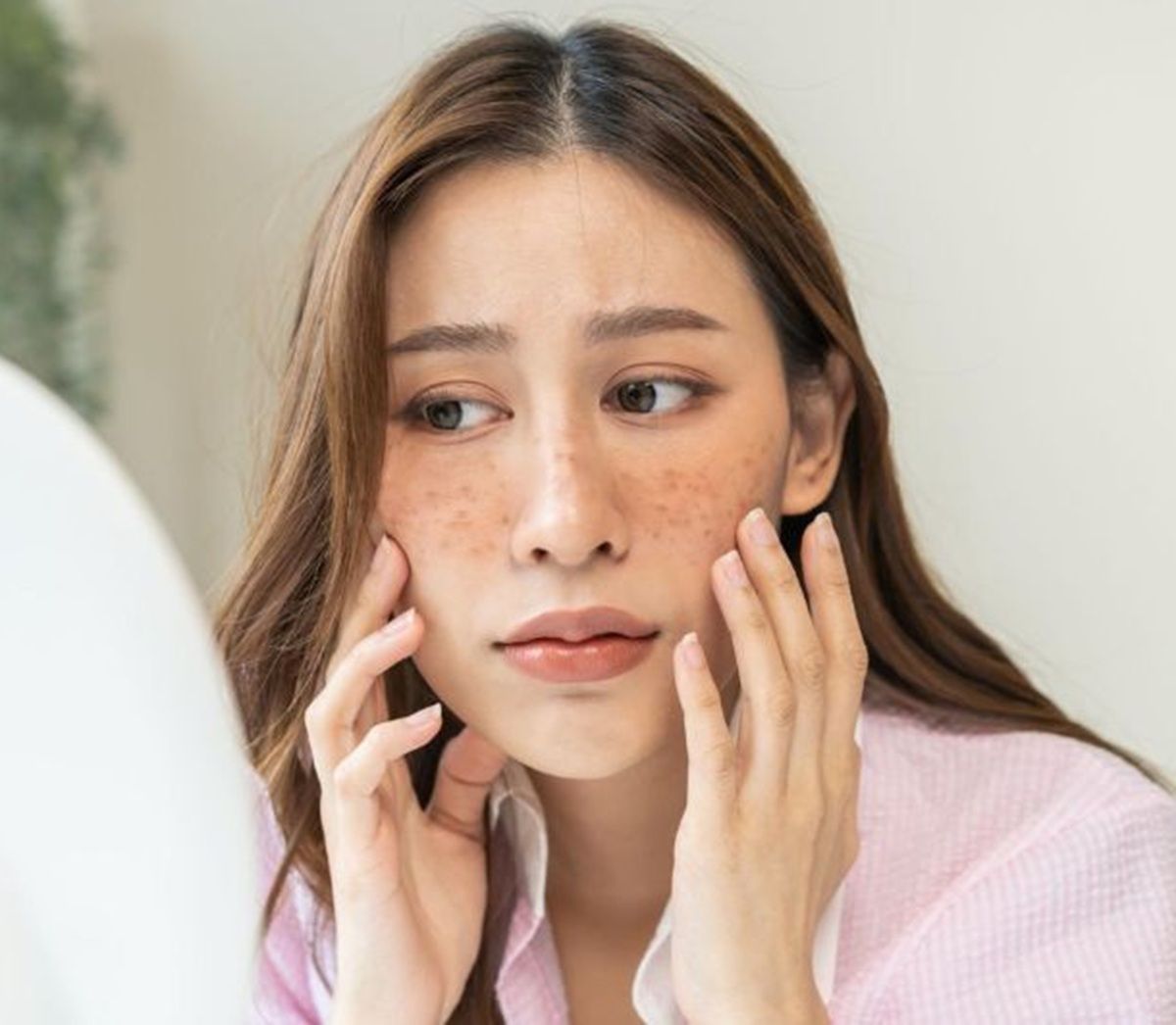 Nám chân sâu: “Vạch trần 4 thủ phạm” khiến da bị nám chân đinh