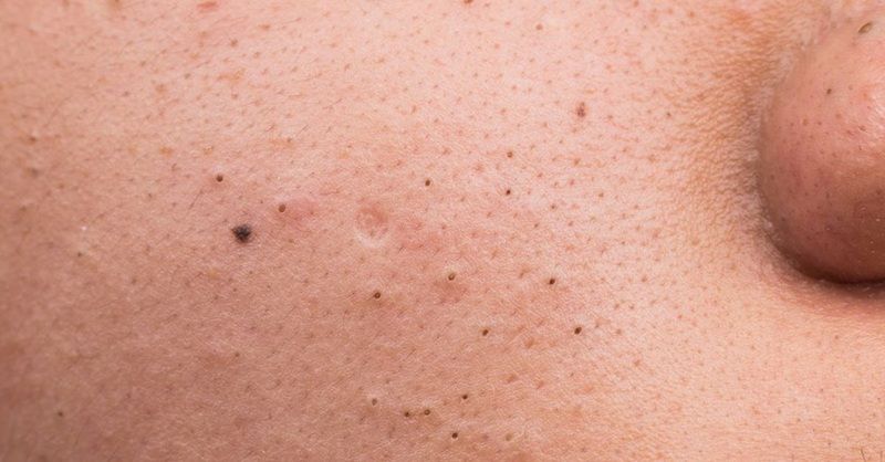 Mụn đầu đen là gì?