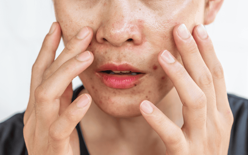 Khi chọn collagen cho da dầu bạn cần sản phẩm nhẹ, dễ hấp thụ, không gây nhờn dính