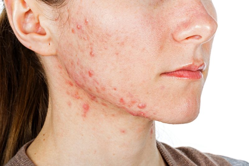 Một số người dùng collagen dạng viên có thể bị nổi mụn hoặc kích ứng