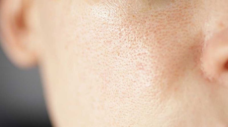 Nguyên nhân gây nên lỗ chân lông to trên da