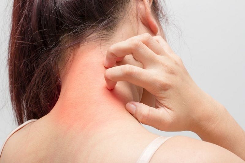 Triệu chứng dị ứng có thể xuất hiện dưới dạng nổi mề đay, ngứa, khó thở