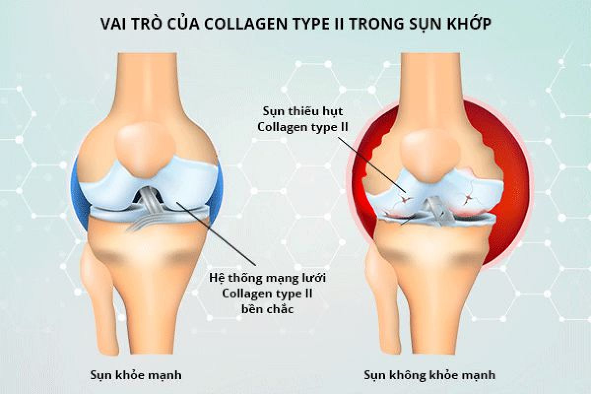 Tìm hiểu về tác dụng của Collagen với xương khớp